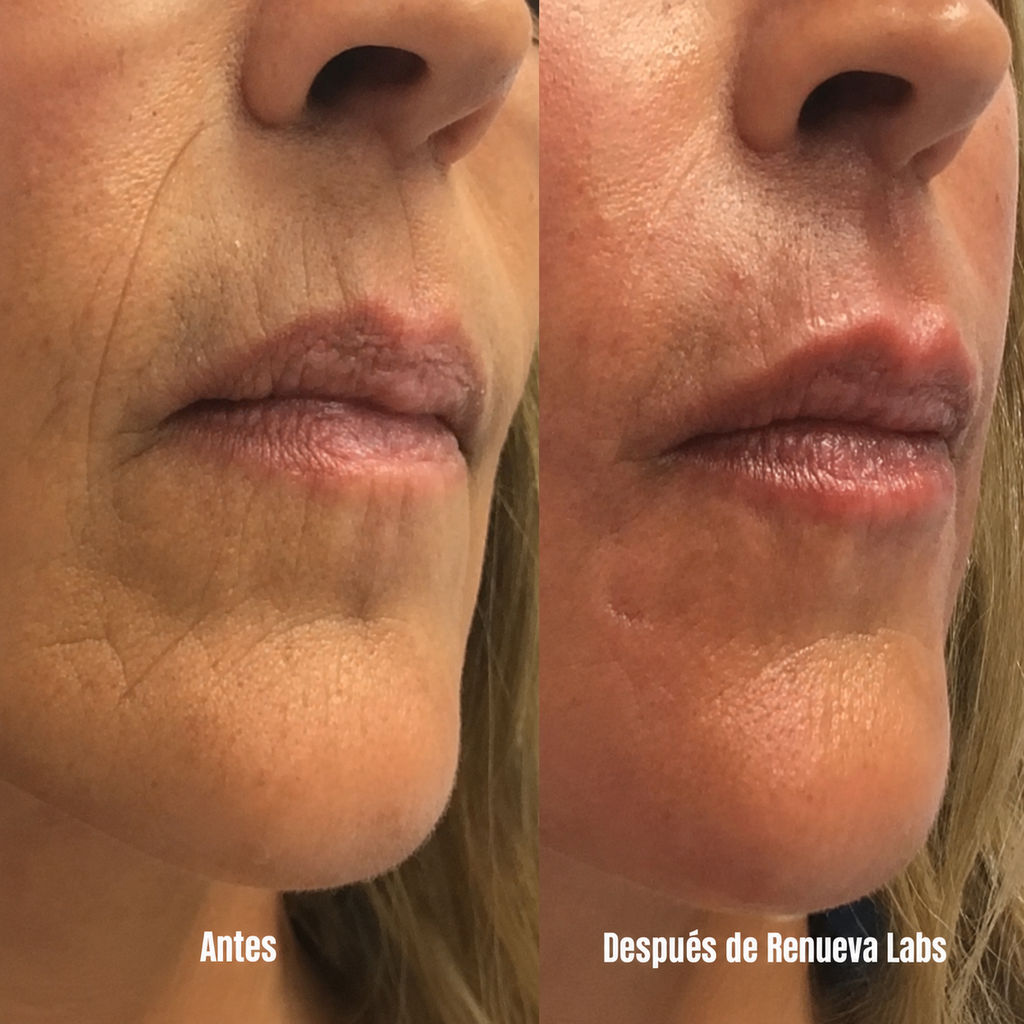 Sistema de microinfusión facial con ácido hialurónico + péptidos