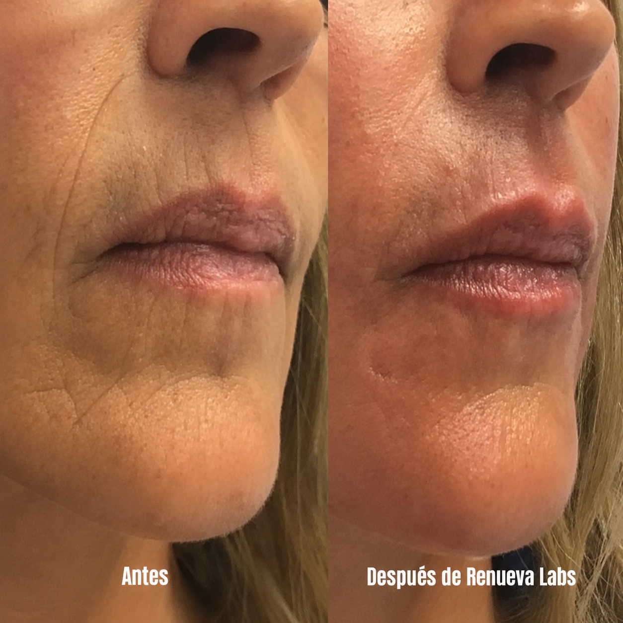 Sistema de microinfusión facial con ácido hialurónico + péptidos