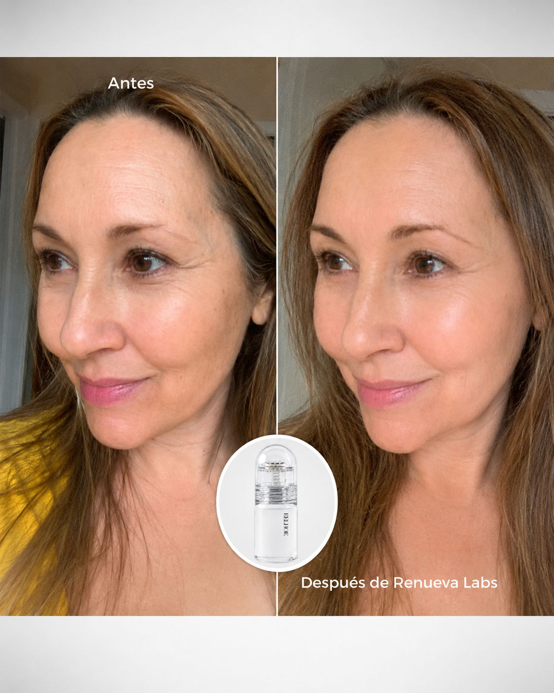 Sistema de microinfusión facial con ácido hialurónico + péptidos