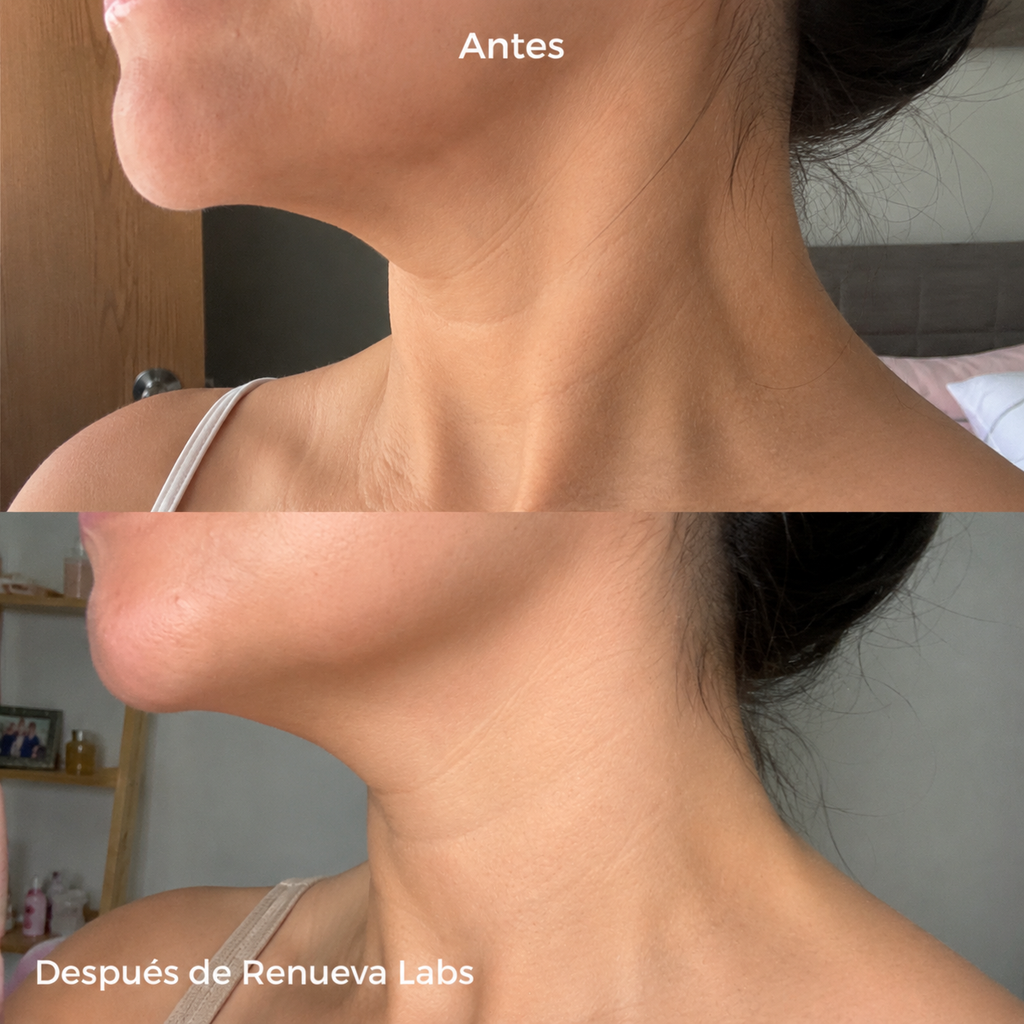 Sistema de microinfusión facial con ácido hialurónico + péptidos